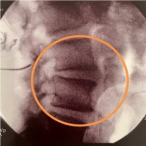 A peri-op lateral fluoro shot of L3-4 displaying a slight spondylolisthesis