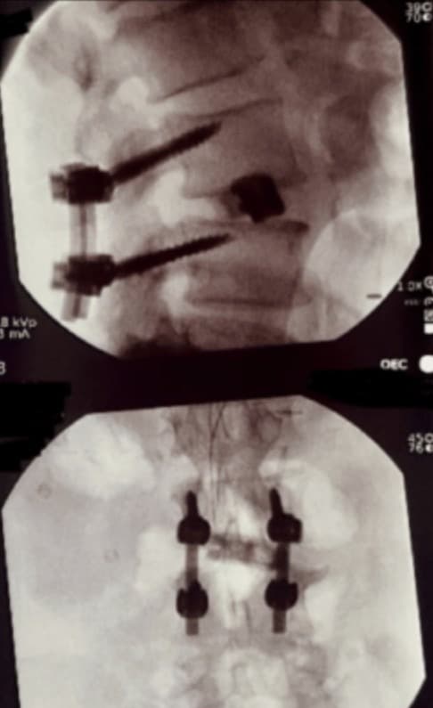 Final construct images following L3-4 decompression and CBT screw and interbody placement