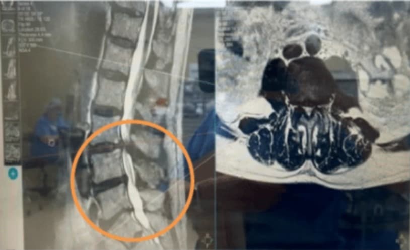 Sagittal and axial MR imaging studies showing canal narrowing and facet hypertrophy