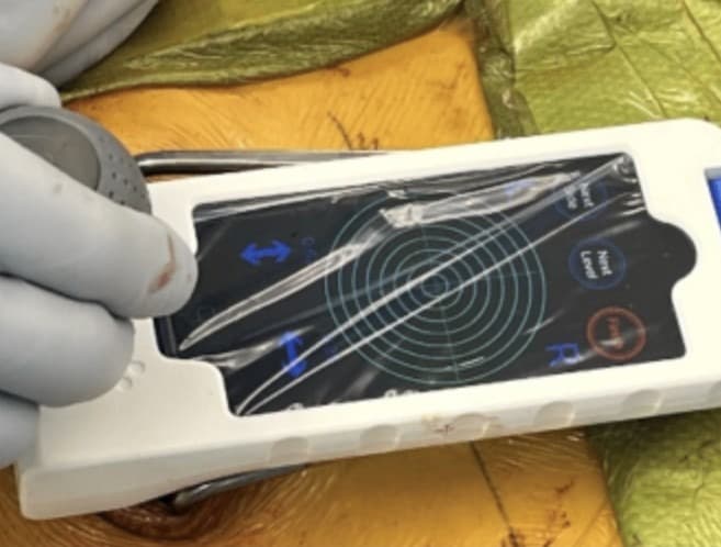 Dr. Thompkins used the Bolt Navigation System to guide screw placement intraoperatively