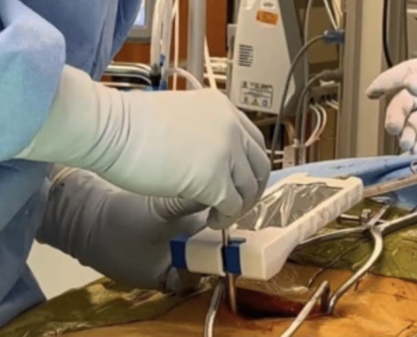 Dr. Thompkins utilizes the Bolt Navigation Unit for accurate trajectory in cortical bone cases