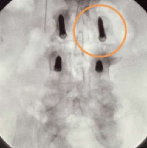 Intraoperative A/P image showing the need for minor adjustment on the right side of L3