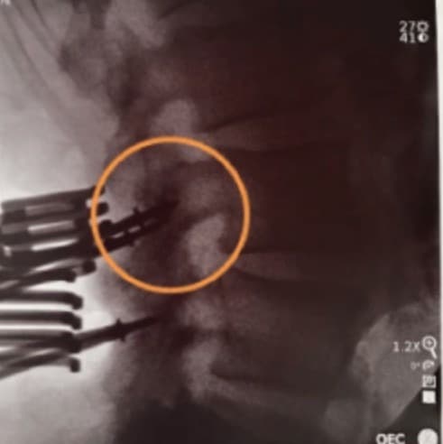 Intraoperative lateral image of the placement of four Caspar pins at L3-4