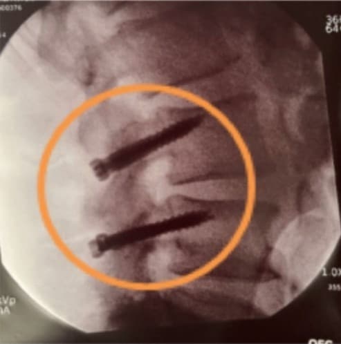 Intraoperative lateral fluoro image of L3-4 showing the cortical screws in position
