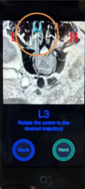 The planned CBT entry and mediolateral screw trajectory