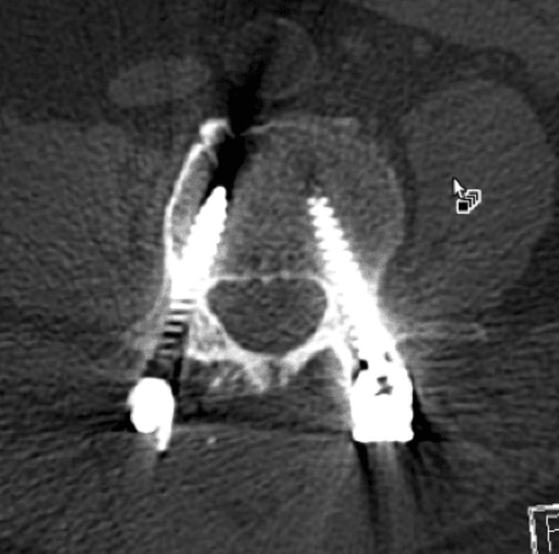Post-op axial CT showing L4-5 pedicle screws, view one