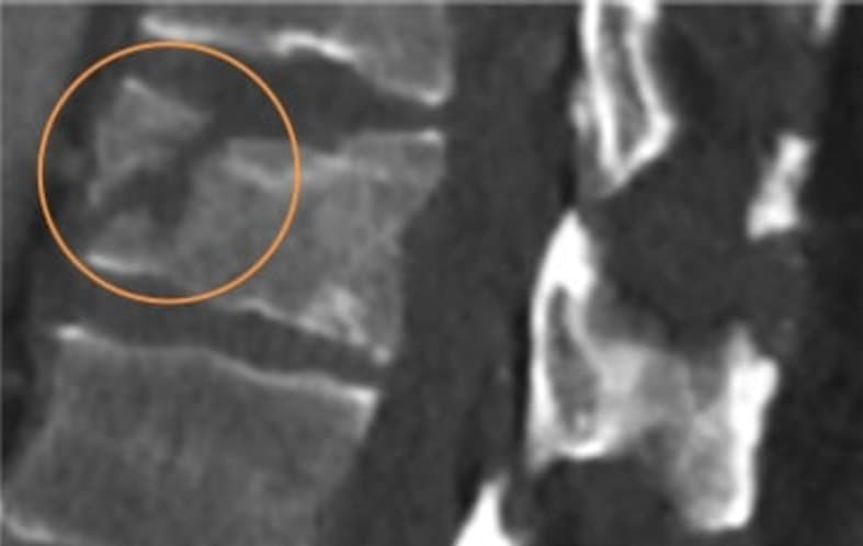 Sagittal MRI image of T12 displaying vertebral fracture to the body, pars, and facets