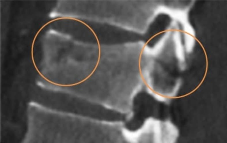 Sagittal MRI image showing acute fracture through the T12 vertebral body