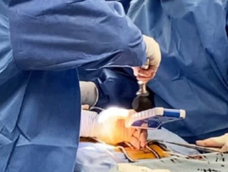 The Bolt Navigation System attached to the pedicle probe