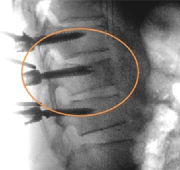 Intraoperative lateral fluoro image with pedicle screws safely in place