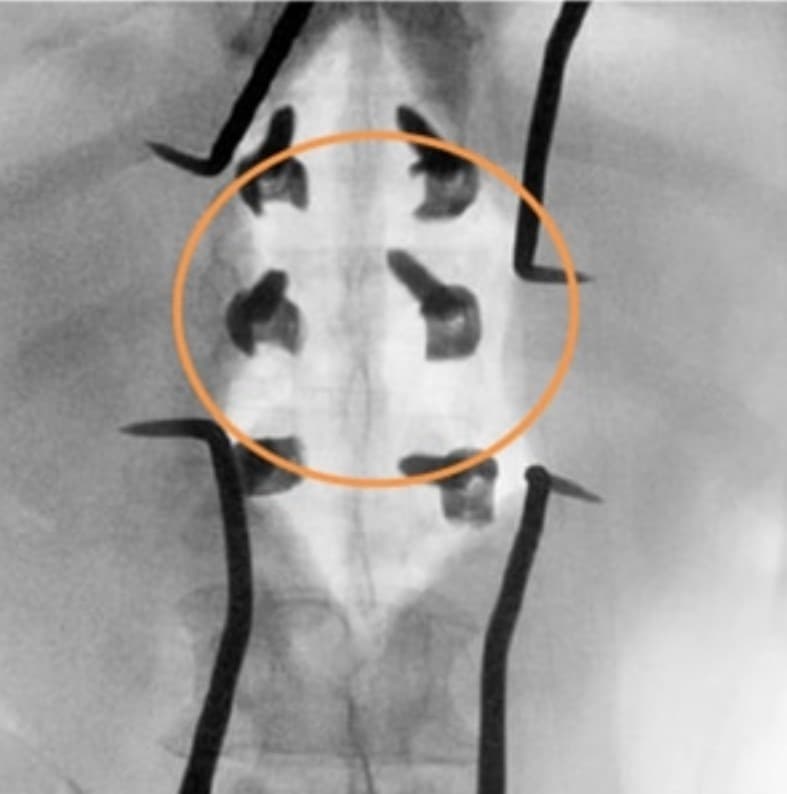 A/P Fluoro image showing final pedicle screw placement