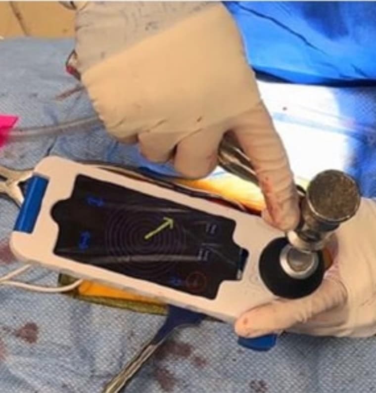 Guiding the pedicle probe using the Bolt Navigation System
