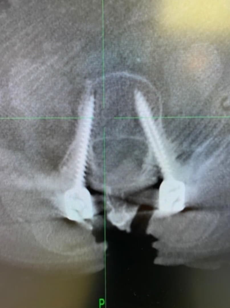 Post-op X-ray confirming the four L4-5 pedicle screws, view one