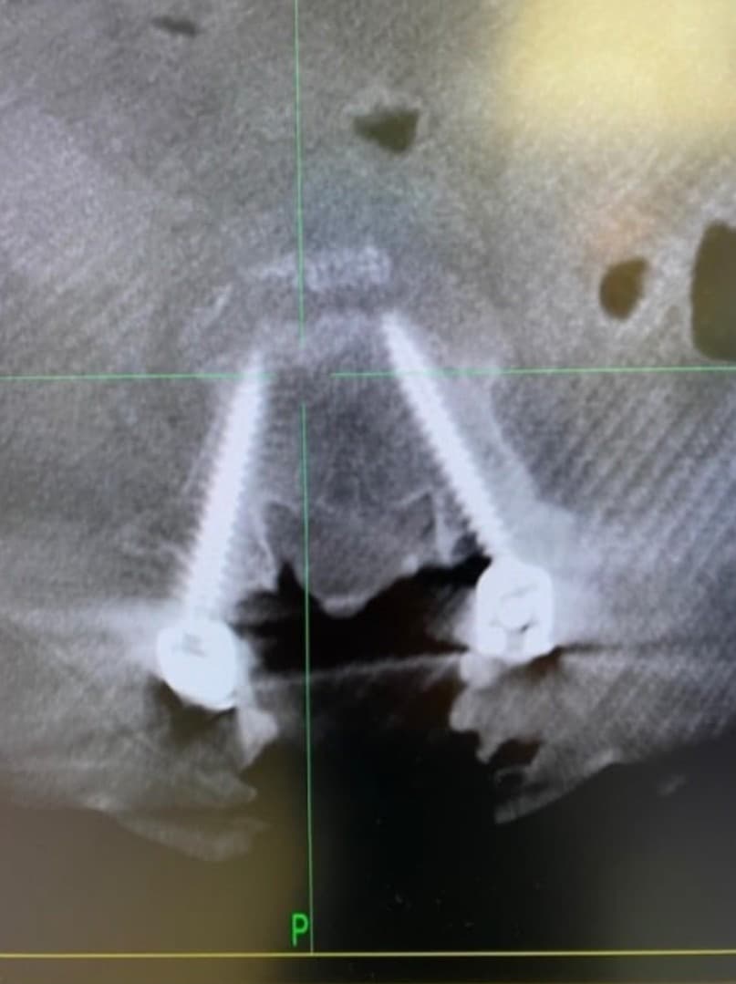 Post-op X-ray confirming the four L4-5 pedicle screws, view two