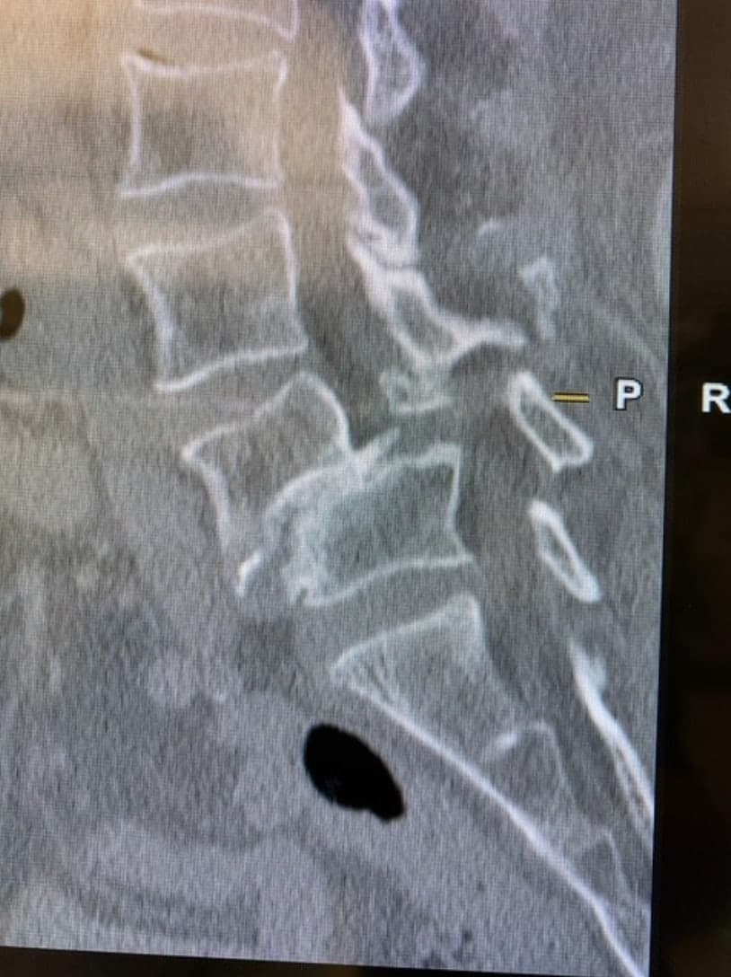 Pre-op imaging of grade III lytic spondylolisthesis at L4-5