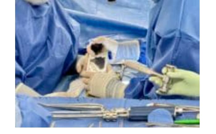 Surgical team using the Bolt Navigation Unit during the first U.S. procedure