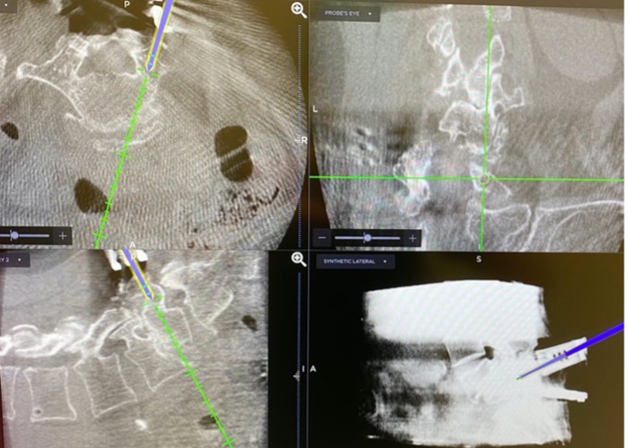 A screenshot of the navigation screen during surgery