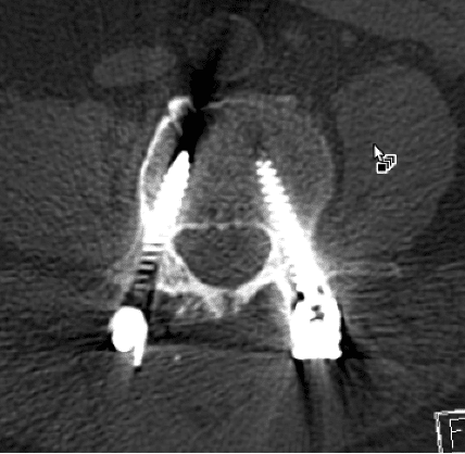 A post op xray of a spine