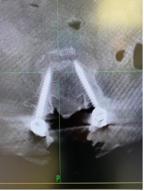 An xray of the spine post surgery