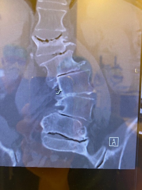 A spine xray before surgery
