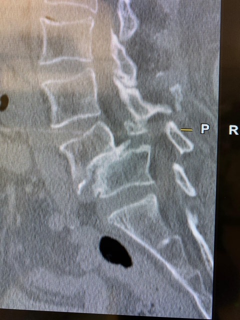 A spine xray before surgery
