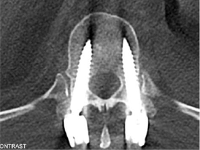 ct scan of repaired t12.